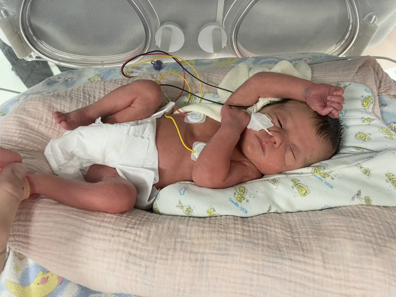 A premature baby lying in an open incubator on a neonatal unit, with monitor leads and a feeding tube